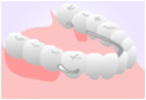 元住吉の歯医者でインプラント治療と入れ歯との比較